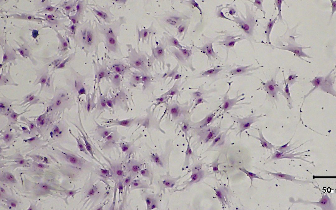 Sclérodermie systémique sévère : 1re démonstration de la sécurité et de la faisabilité de l’administration des cellules mésenchymateuses stromales