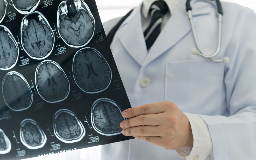 AVC : une récidive sur cinq peut être évitée