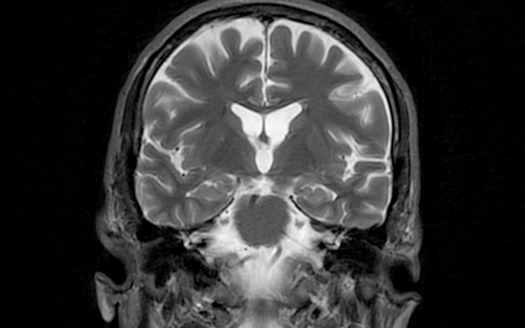 Maladie d’Alzheimer : la cosmochimie au service du cerveau