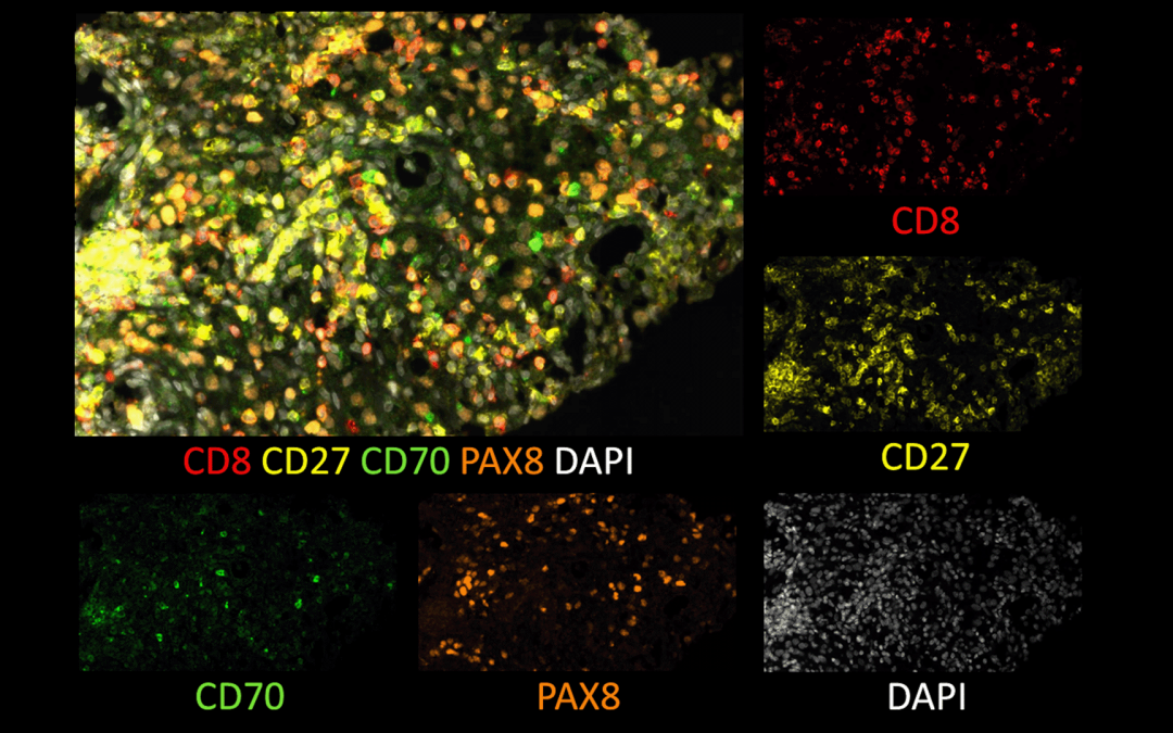 Immunotherapy: Discovery of a Blood-soluble Biomarker advancing Customized Cancer Treatment